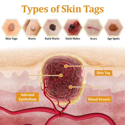 flysmus™ TagCure Bee Venom Skincare Cream🐝(Removes Warts & Moles)