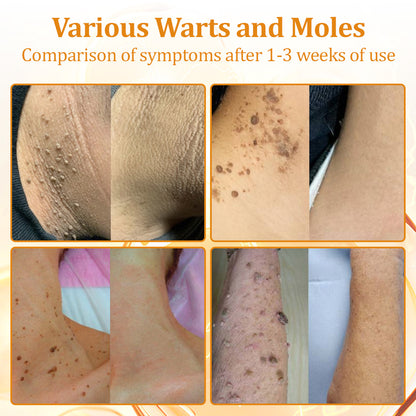 flysmus™Tagheal Bee Venom Mole and Wart Treatment Cream🐝( Dermatologist Recommended👩‍⚕️✅）