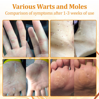 flysmus™Tagheal Bee Venom Mole and Wart Treatment Cream🐝( Dermatologist Recommended👩‍⚕️✅）