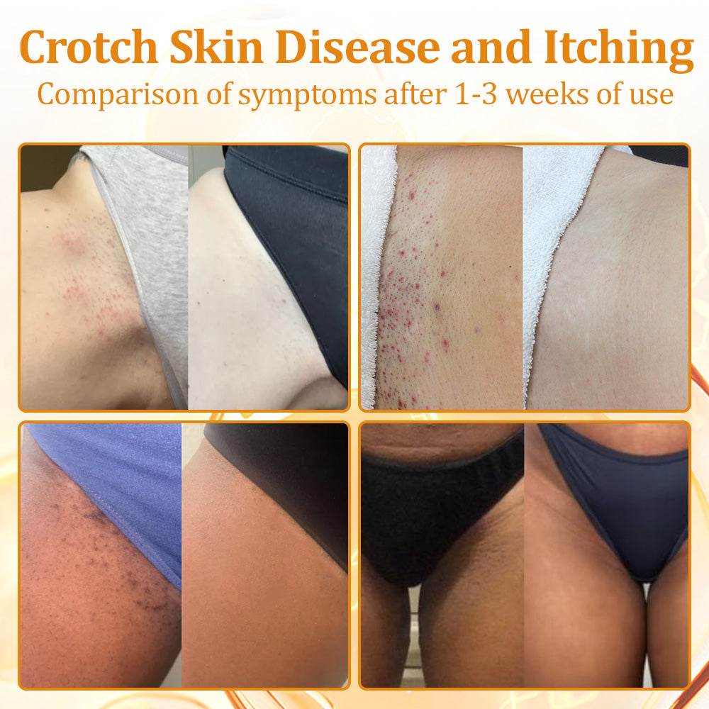 flysmus™Tagheal Bee Venom Mole and Wart Treatment Cream🐝( Dermatologist Recommended👩‍⚕️✅）