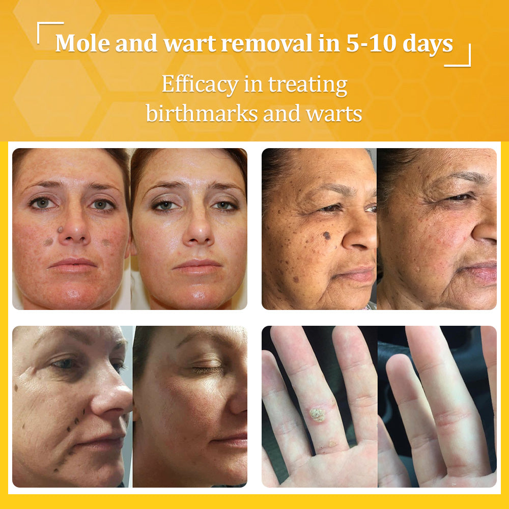 flysmus™ TagCure Bee Venom Skincare Cream🐝(Removes Warts & Moles)