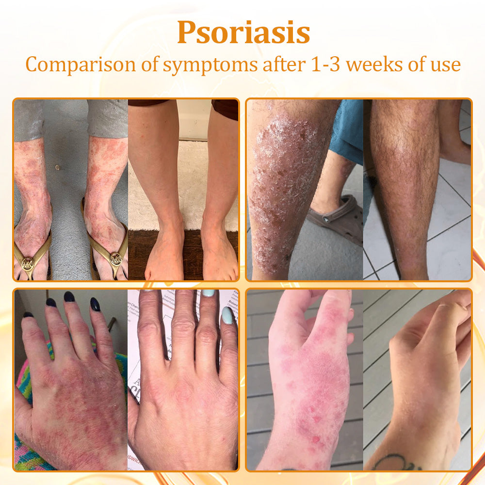 flysmus™Tagheal Bee Venom Mole and Wart Treatment Cream🐝( Dermatologist Recommended👩‍⚕️✅）